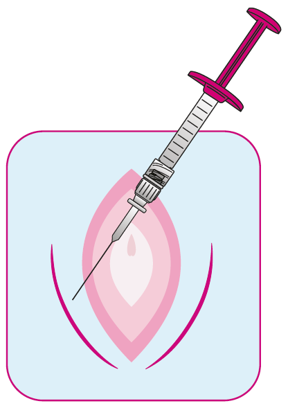 Regenyal Armonia Hyaluronsäure: Innovative Lösung für Intimverjüngung und Genitalkorrektur 2x1ml Regenyal Armonia Hyaluronsäure: Innovative Lösung für Intimverjüngung und Genitalkorrektur 2x1ml