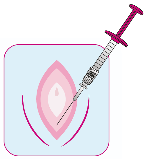 Regenyal Armonia Hyaluronsäure: Innovative Lösung für Intimverjüngung und Genitalkorrektur 2x1ml Regenyal Armonia Hyaluronsäure: Innovative Lösung für Intimverjüngung und Genitalkorrektur 2x1ml